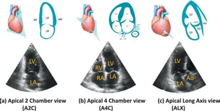 Are AP2 cavity back?