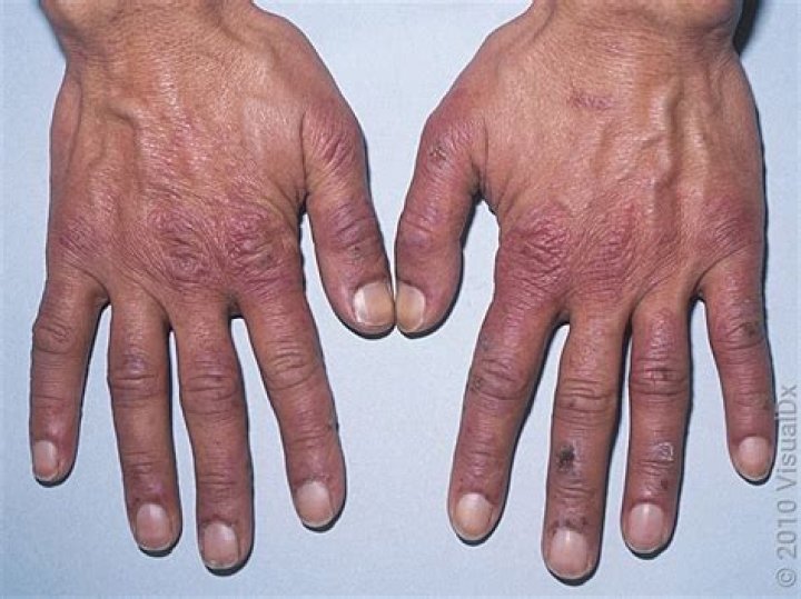 Are chilblains?