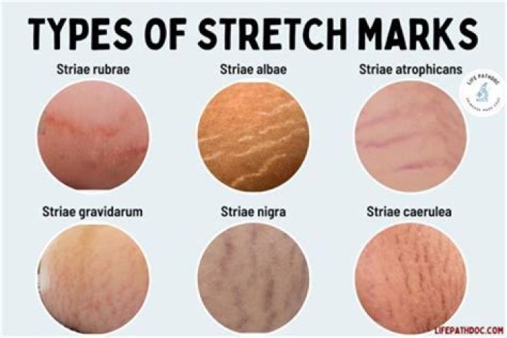 Are iron marks permanent?