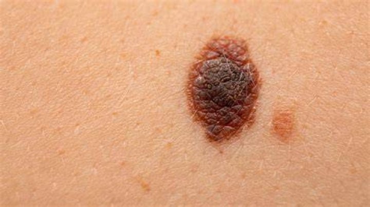 Are melanomas raised?