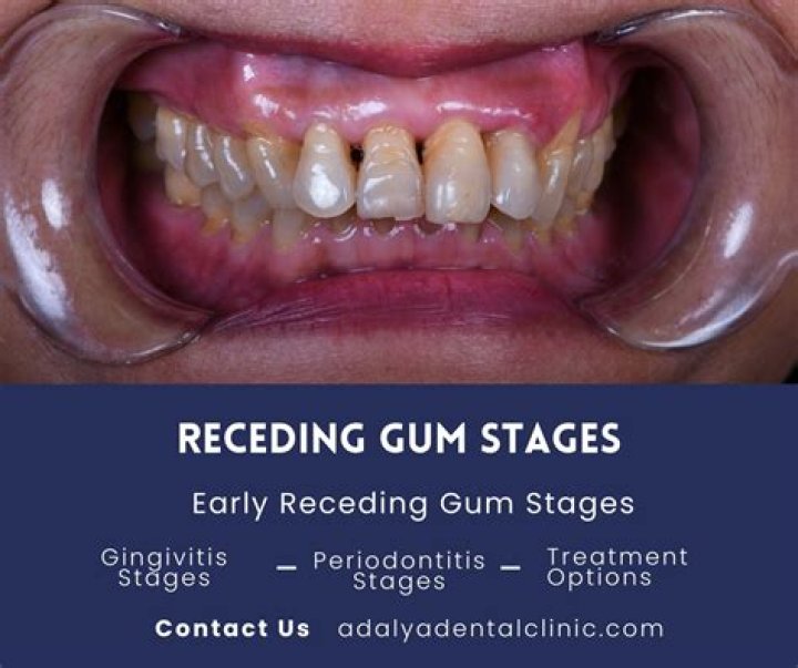 At what age do gums start receding?