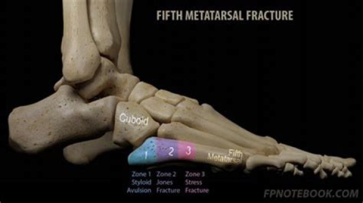 Can a 5th metatarsal fracture heal without a cast?
