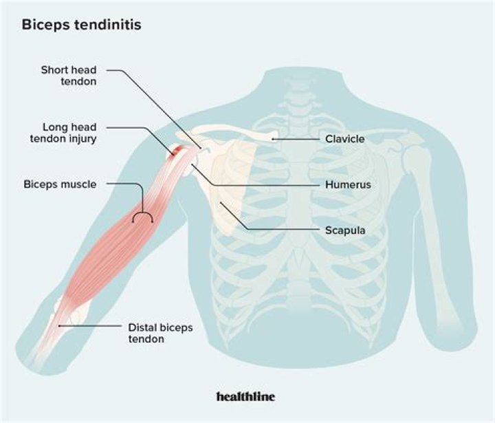 Can a car accident cause shoulder tendonitis?