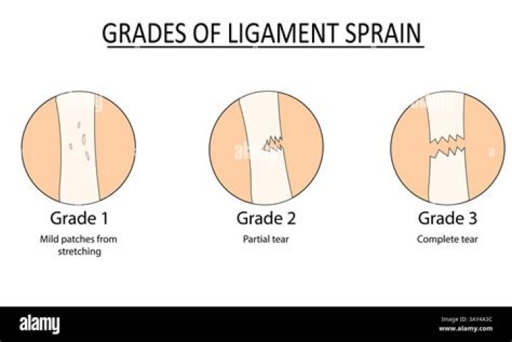 Can a Grade 3 ligament tear heal on its own?