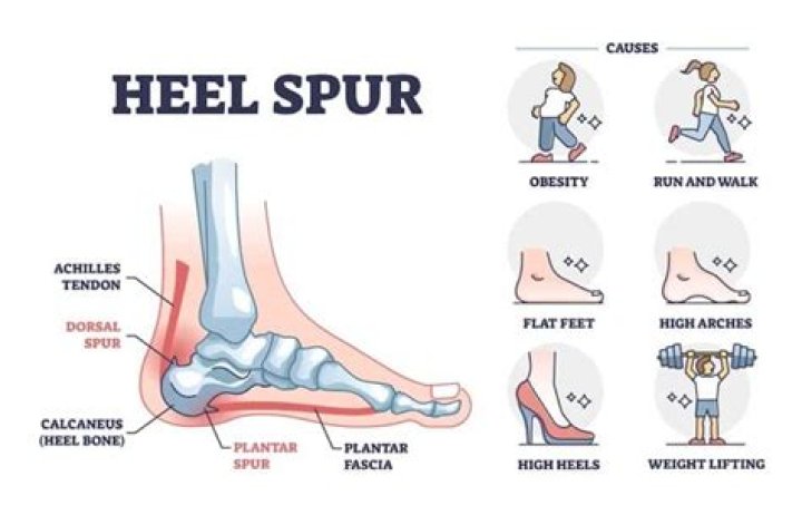 Can a heel spur cause lower back pain?