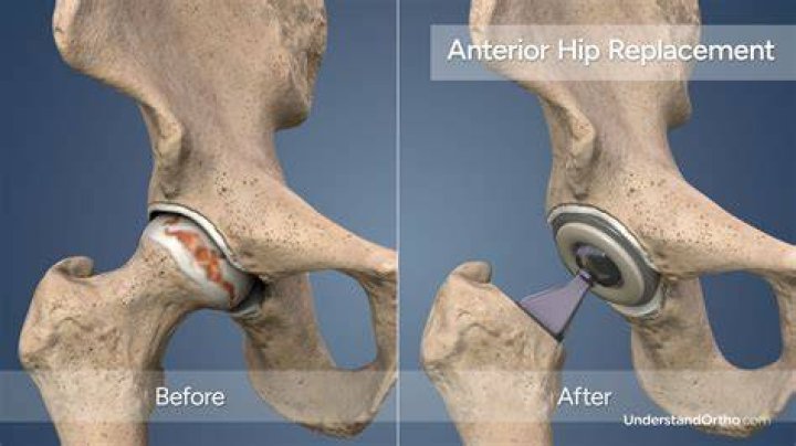 Can a hip replacement last 40 years?