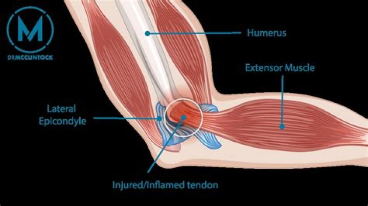 Can a pinched nerve cause tennis elbow?