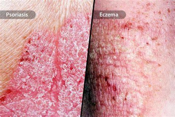 Can a psoriasis patient live a normal life?
