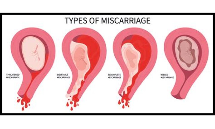 Can an ultrasound be wrong about miscarriage?
