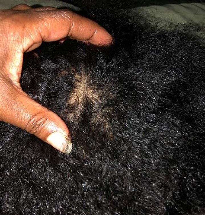 Can black people get lice in their hair?