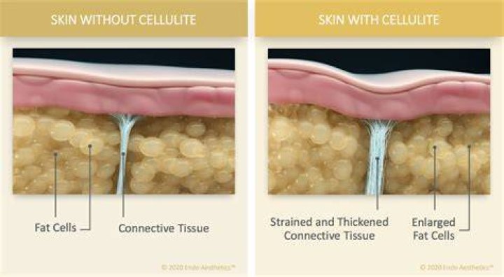 Can cellulite go away?