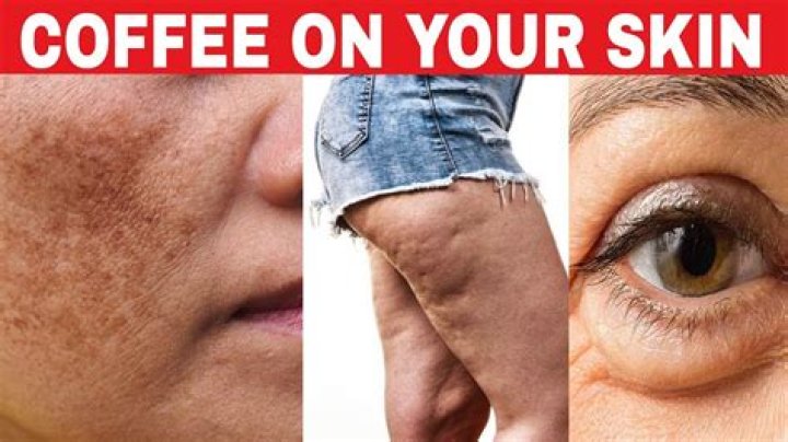 Can coffee cause skin rashes?