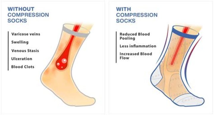 Can compression socks cause blood clots?