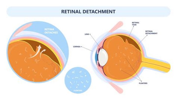 Can exercise cause retinal tears?