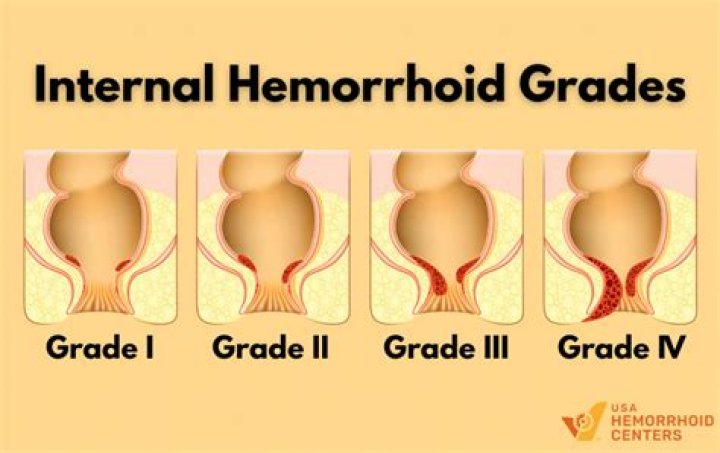 Can Grade 3 hemorrhoids go away on their own?