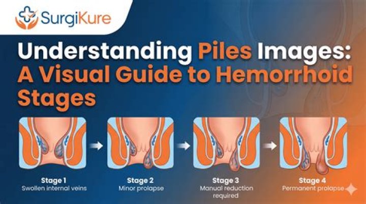 Can Honey Cure Piles?