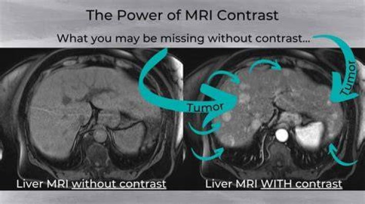 Can I drive after MRI with contrast?