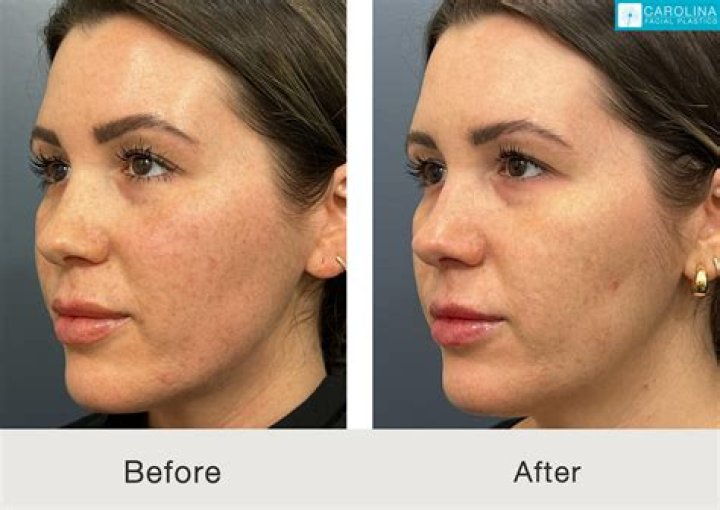 Can I exfoliate after BBL laser?
