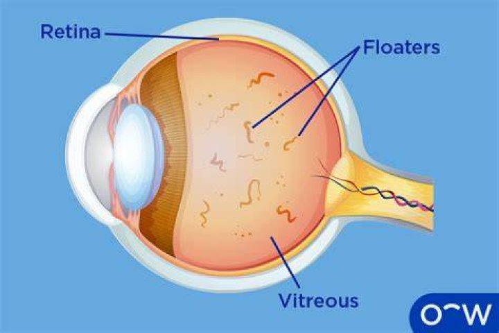 Can I live with floaters?