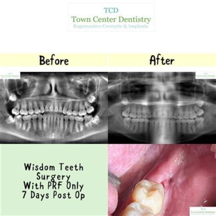 Can I walk around after wisdom teeth removal?