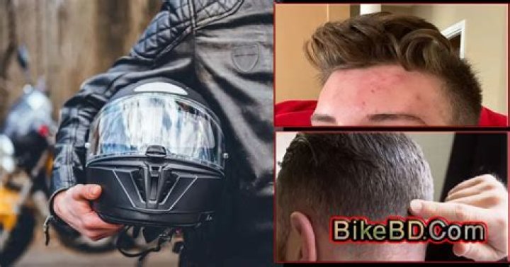 Can motorcycle helmets cause acne?