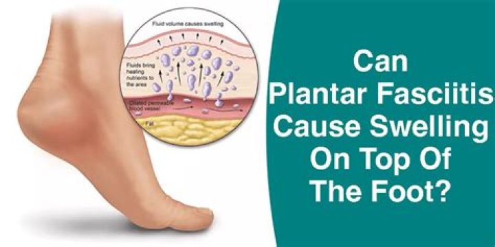 Can plantar fasciitis cause your feet to swell?