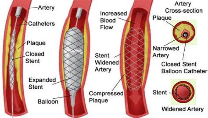 Can stents be removed from arteries?