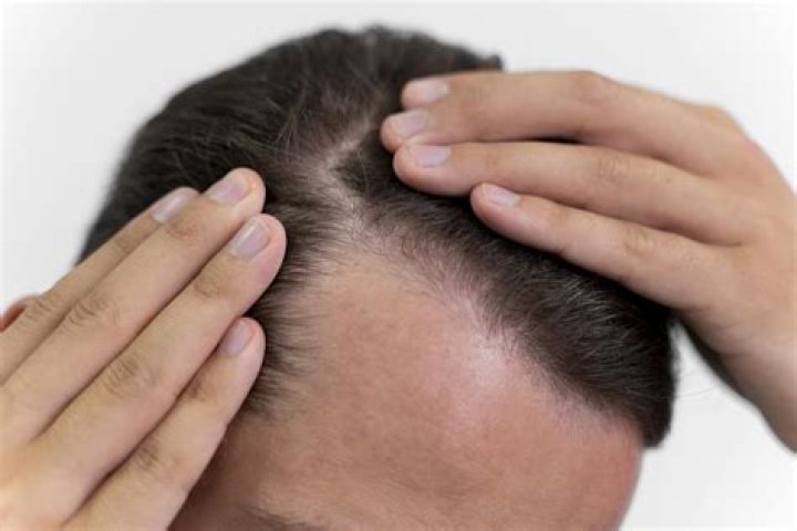 Can stress cause balding?