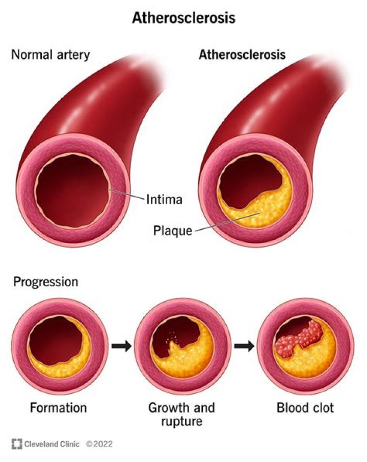 Can stress cause plaque in arteries?