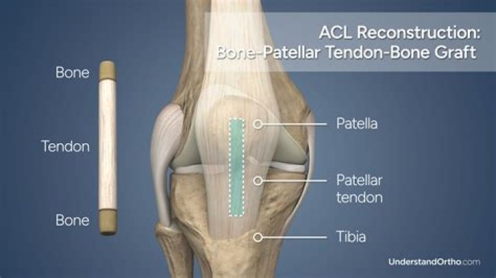 Can torn ACL repair itself?