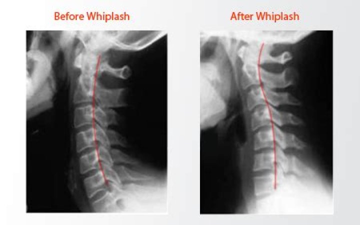 Can whiplash be seen on xray?