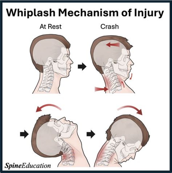 Can whiplash cause pain years later?