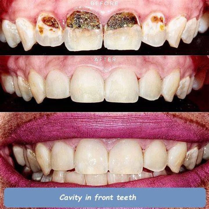 Can you ask a dentist to remove all my teeth?