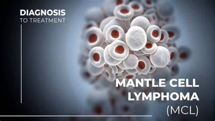 Can you beat mantle cell lymphoma?