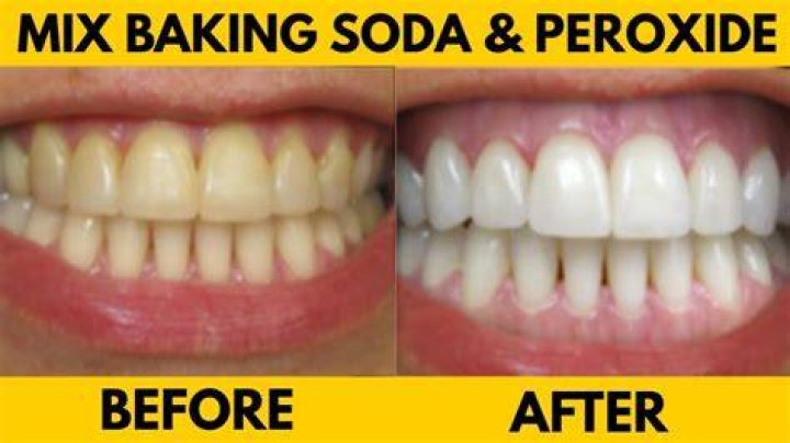 Can you brush with baking soda and peroxide daily?