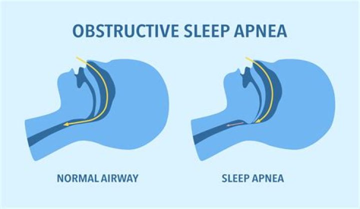Can you develop sleep apnea out of nowhere?