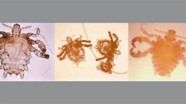 Can you get crabs if you have no hair?