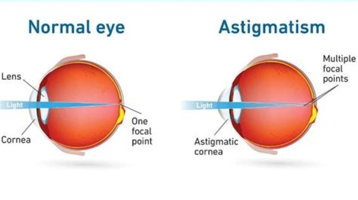 Can you have astigmatism in only one eye?