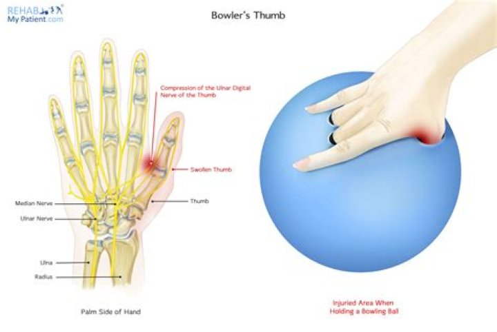 Can you hurt your thumb bowling?