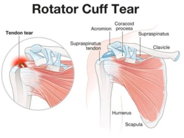 Can you live with a full-thickness rotator cuff tear?