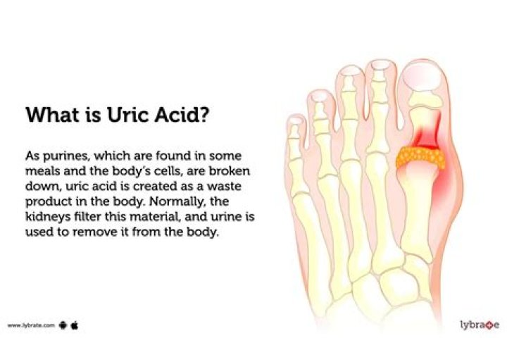 Can you pee out uric acid?