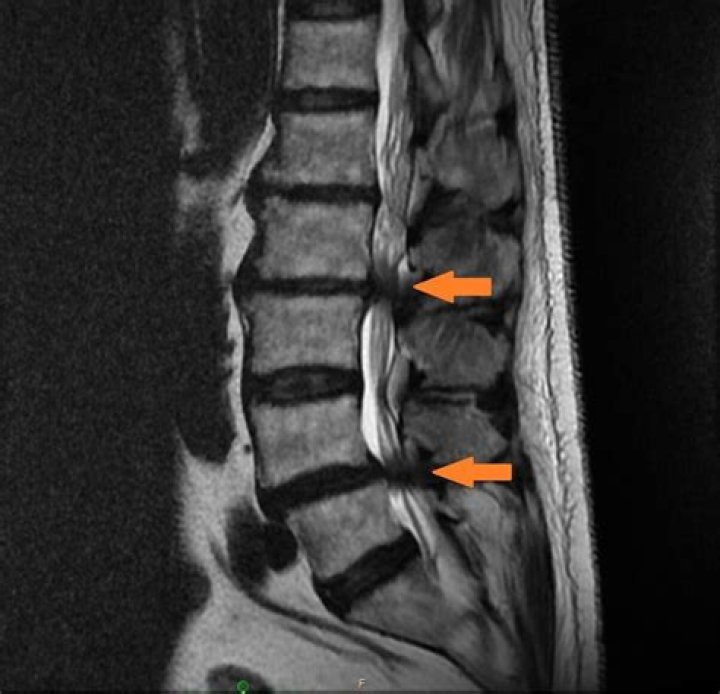 Can you see bone spurs on an MRI?