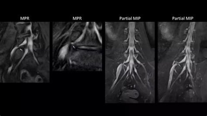 Can you see muscle inflammation on an MRI?