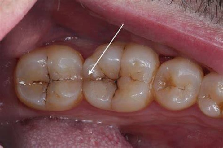 Can you smell a rotten tooth?