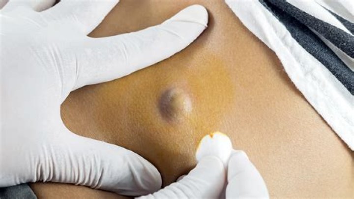 Can you squeeze out a cyst?
