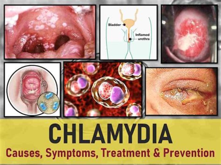 Can you still have chlamydia after taking doxycycline?
