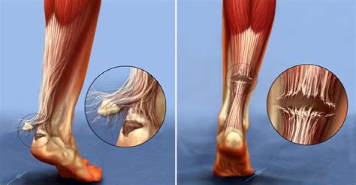 Can you walk with a torn tendon in your foot?