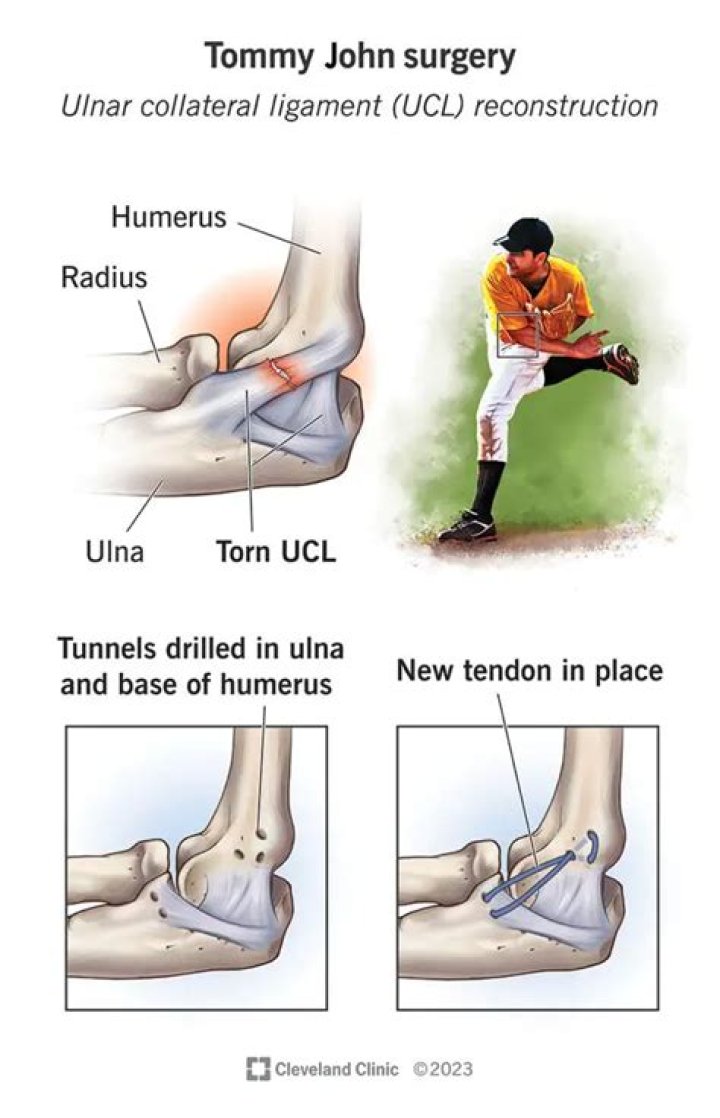 Did Ben Joyce have Tommy John surgery?