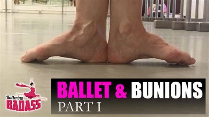Do ballerinas get bunions?