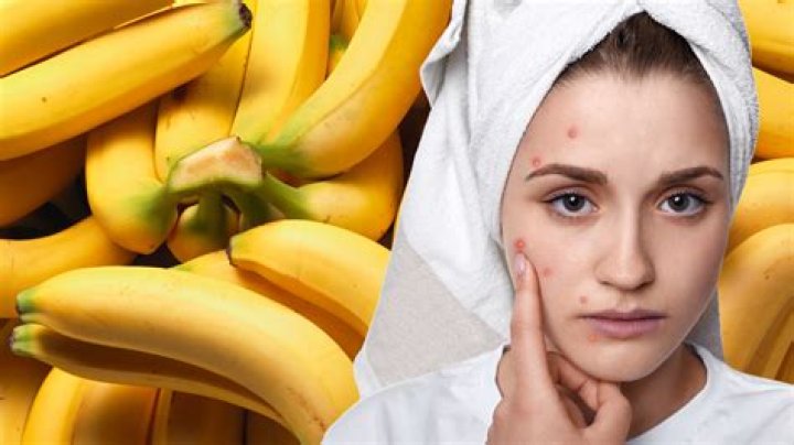 Do bananas cause acne?
